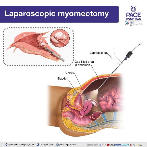 Fibromas Uterinos Diagnóstico Y Tratamiento Mayo Clinic 55 OFF